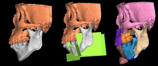 3D surgical planning of the SMA as part of the jaw advancement surgery for patients with severe obstructive sleep apnea.